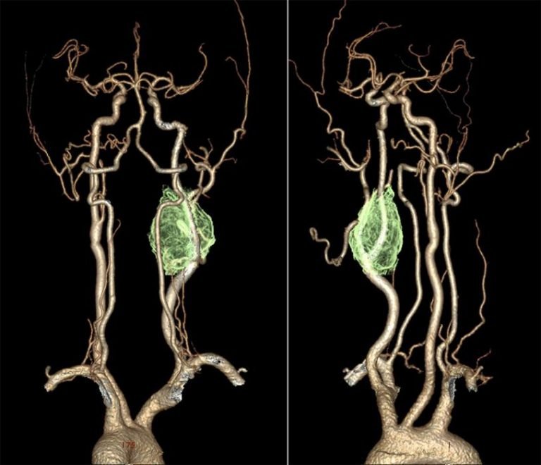 Carotid Body Tumors Chemodectoma Clinical Features And Treatment