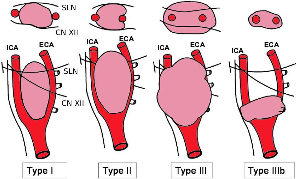 Shamblin classification of carotid body tumors