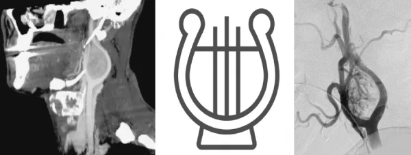 lyers sign carotid body tumor