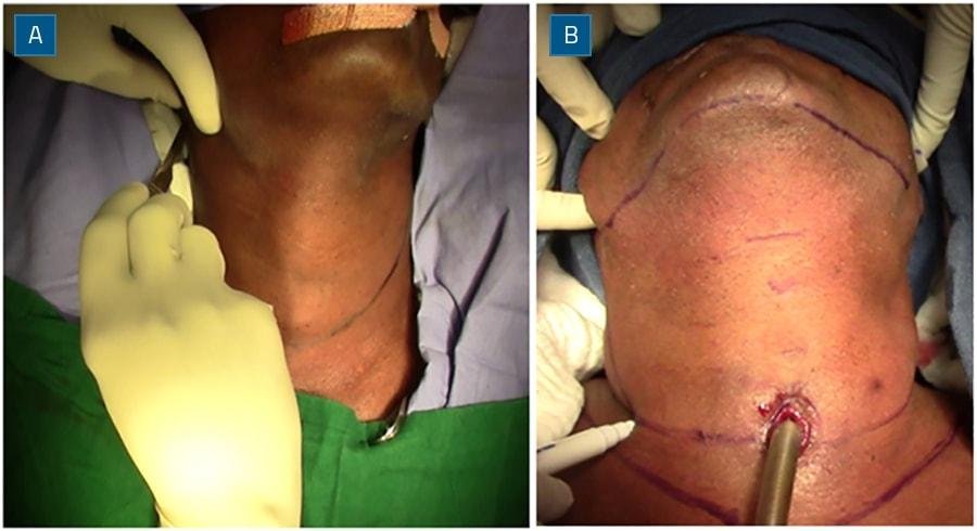 Indications and Contraindications for total laryngectomy