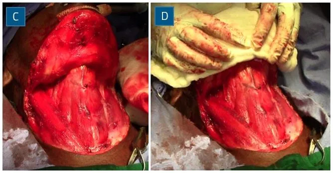 Subplatysmal flap elevation