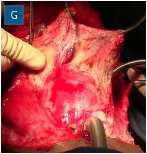 Anterior jugular vein ligation