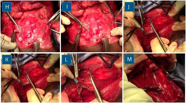 Omohyoid mobilisation