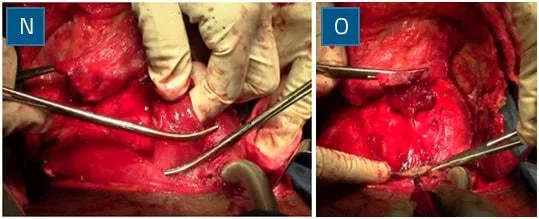 Strap muscle division