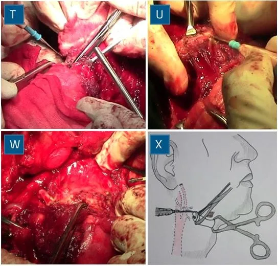 Hyoid skeletonisation