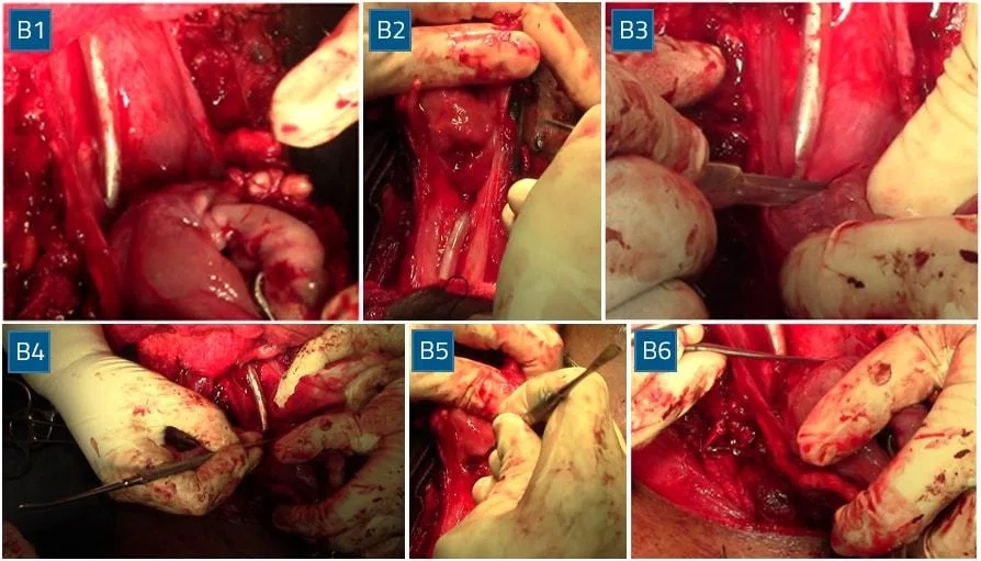 Posterior separation