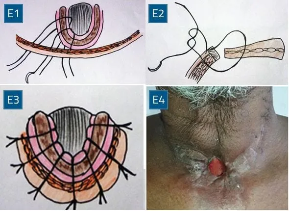 Stoma creation