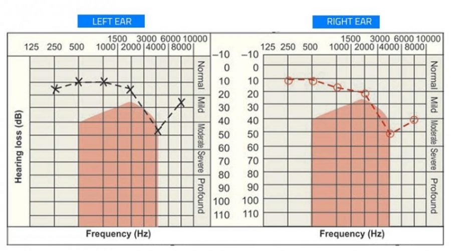 Noise Induced Hearing Loss (NIHL) - Dr Sanu P Moideen