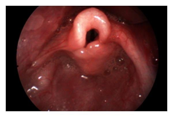 Laryngomalacia – clinical features, surgical and medical management