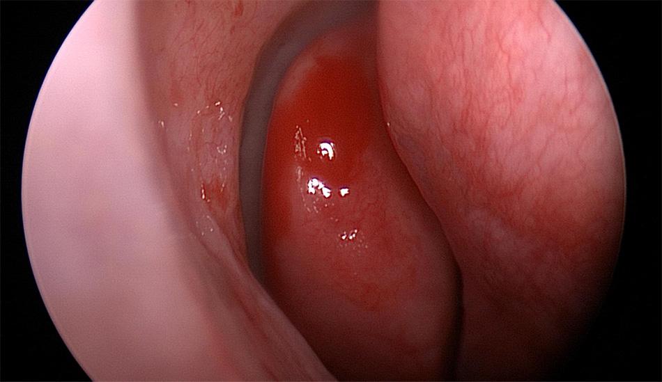 Nasal endoscopy showing Concha Bullosa . Isaac Namdar