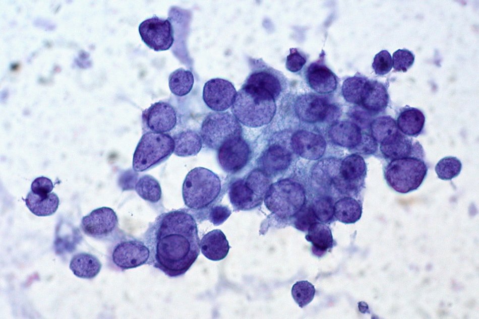 Papillary Carcinoma thyroid histopathology