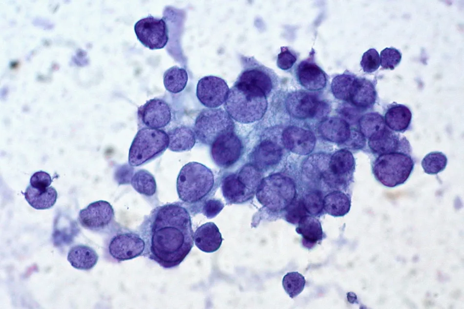 Bethesda system for Thyroid Malignancies 2007, 2017 and 2023 Updates