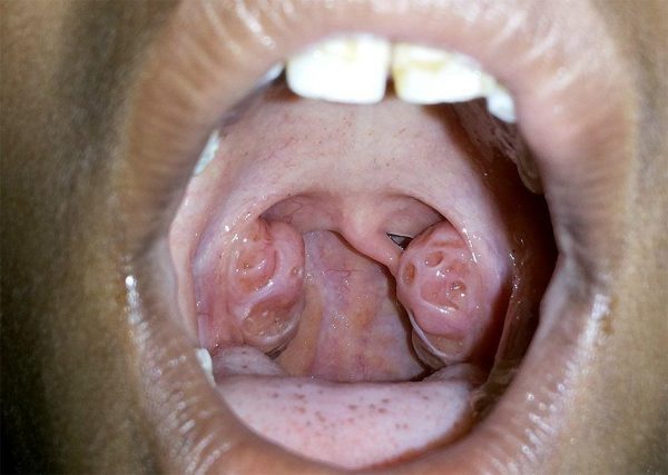Enlarged tonsils in a kid