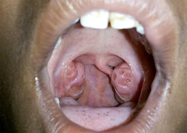 Enlarged tonsils in a kid