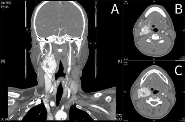 Carotid Body Tumors / Chemodectoma - Clinical features and Treatment
