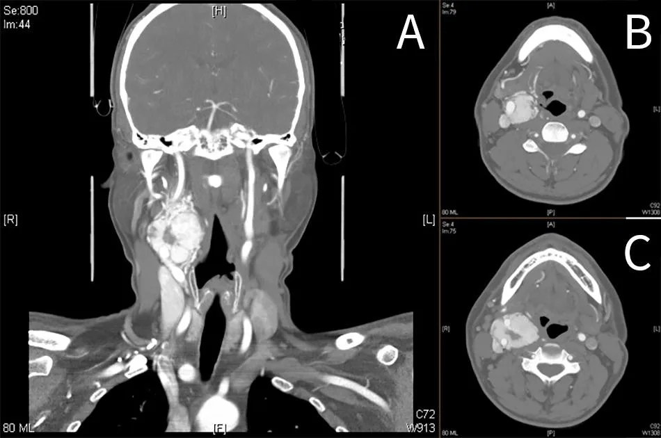Carotid body tumor