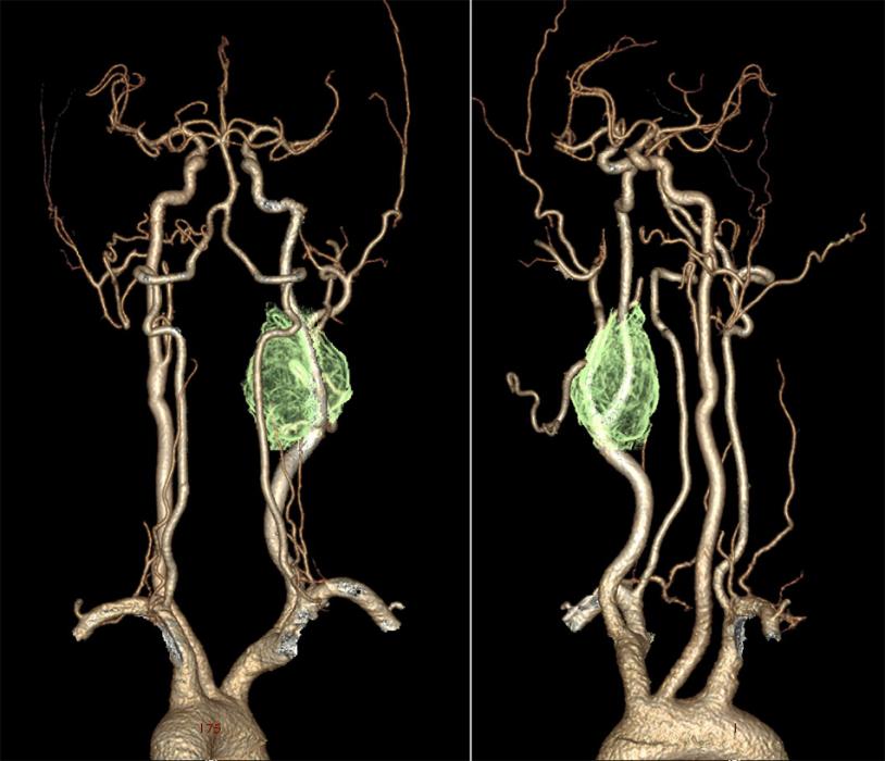carotid body tumor - digital subtraction angiography