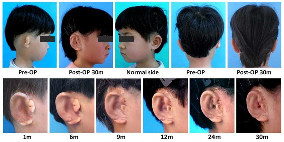Microtia and 3D-printed ears © EBioMedicine