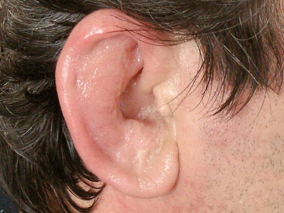 ENT Quiz – Painful swelling of ear in a middle aged man