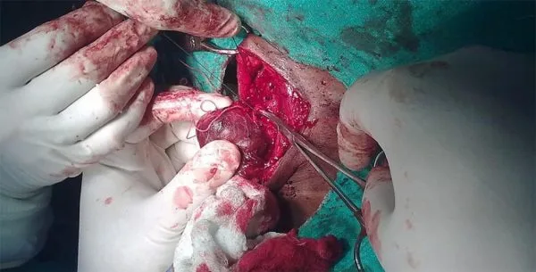 Thyroidectomy