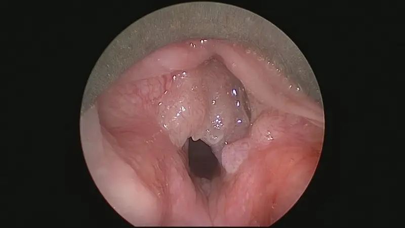 Recurrent Respiratory Papillomatosis – Clinical features, Diagnosis and Treatment