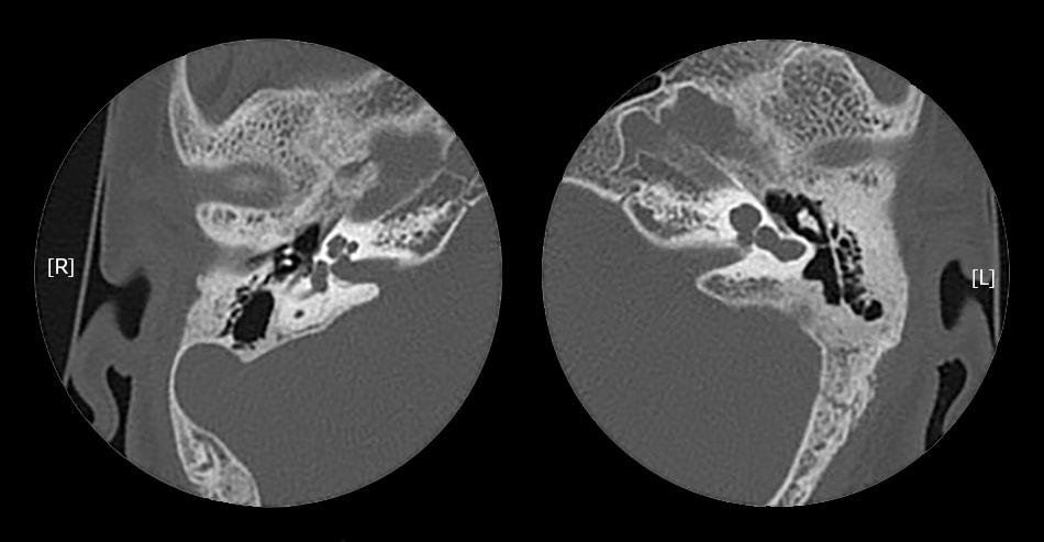 ENT Quiz – Recurrent Meningitis with Hearing loss