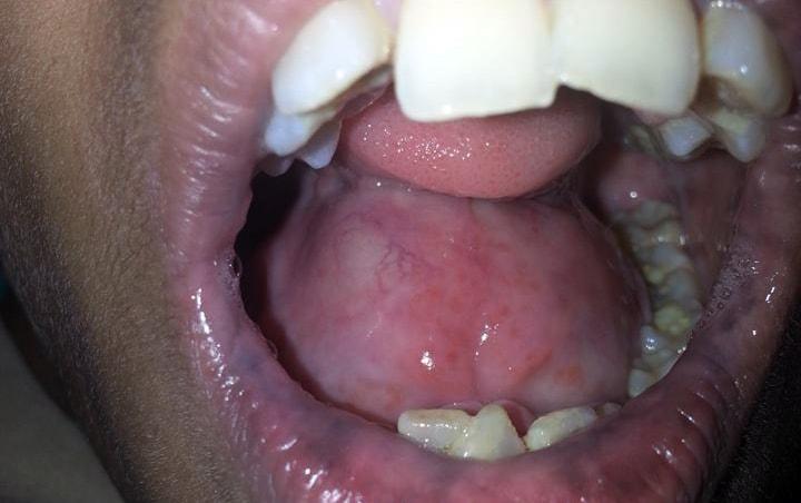 Intra oral swelling in a nine year old child