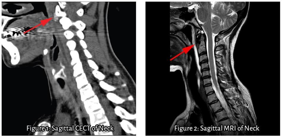 Calcific prevertebral tendinitis