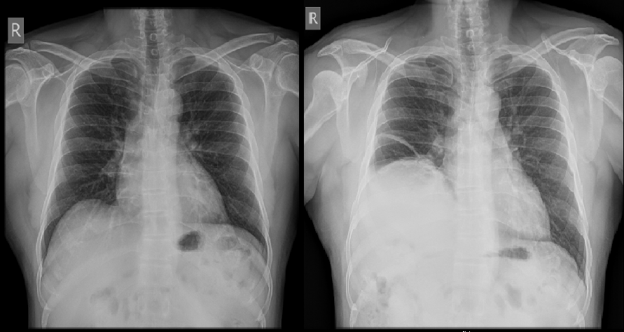 Phrenic palsy