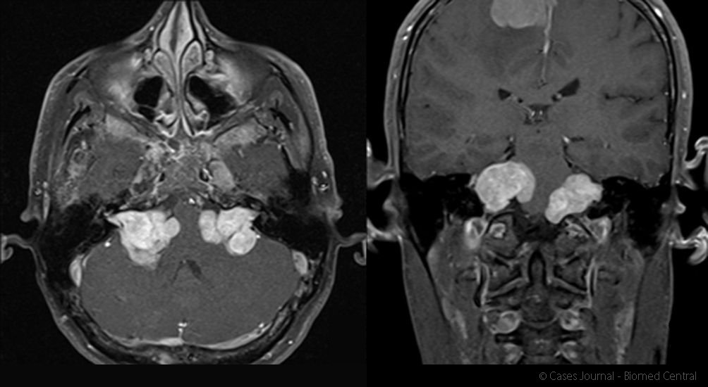 acoustic neuroma