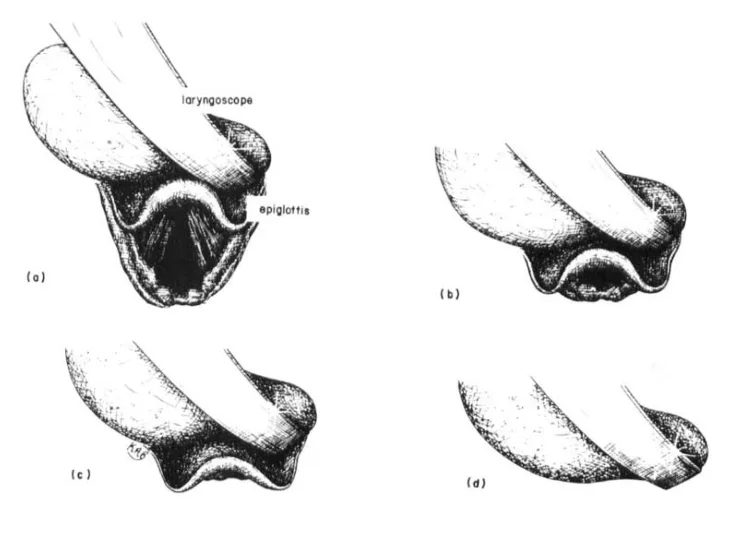 Cormack – Lehane Grading System