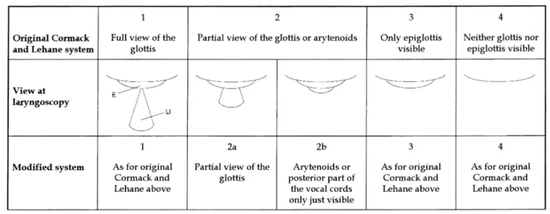 Yentis Modified version of the Cormack and Lehane scoring system