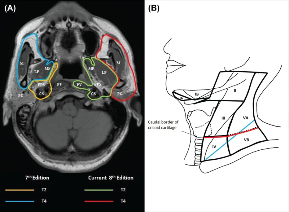 Carcinoma nasopharynx staging