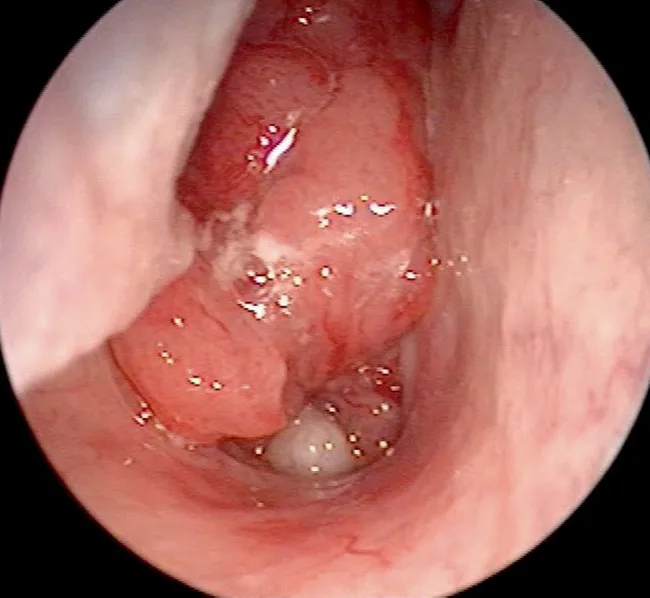 Nasopharyngeal carcinoma dne