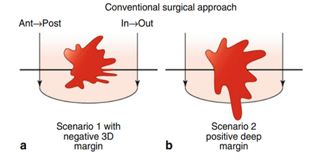 Circumferential resection