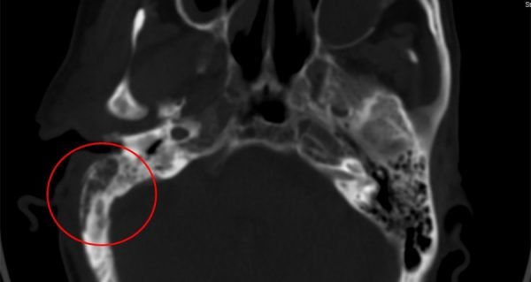 Radiological findings in Malignant Otitis Externa