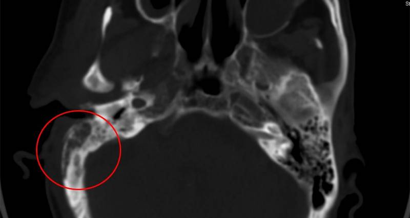 Radiological findings in Malignant Otitis Externa