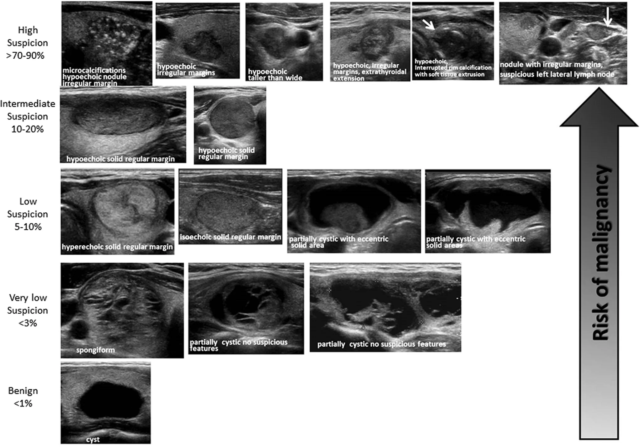 ATA nodule sonographic patterns and risk of malignancy.