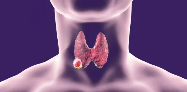 Medullary Thyroid Carcinoma – Comprehensive overview