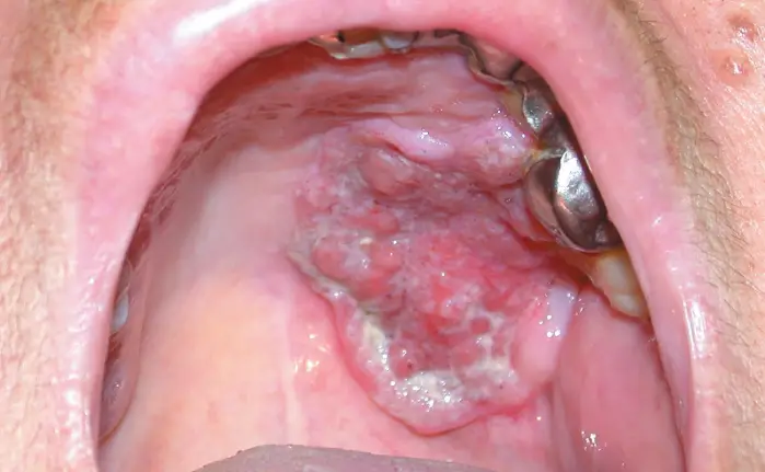 oropharyngeal cancer