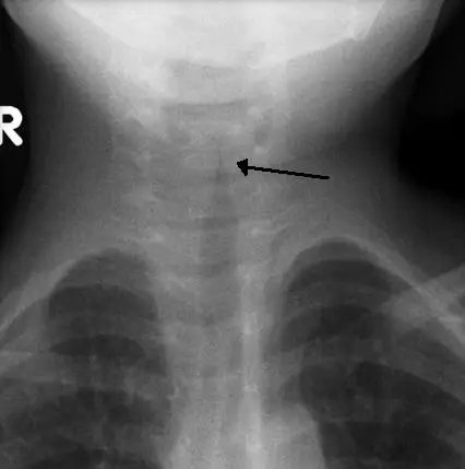 Subglottic Stenosis – Clinical Features and Treatment