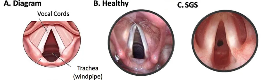Subglottic stenosis