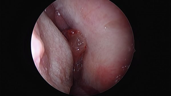 nasal papilloma treatment