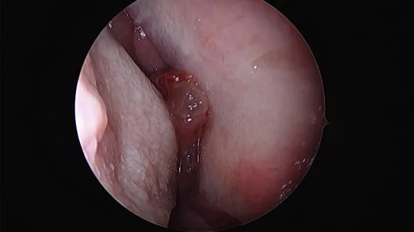 Inverted Papilloma Nasal Cavity