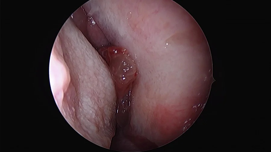 papilloma in nostril