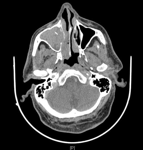 Sinonasal inverted papilloma - Axial CT image showing mass filling the right maxillary sinus destroying lateral wall of nose and mass filling the posterior nasal cavity.