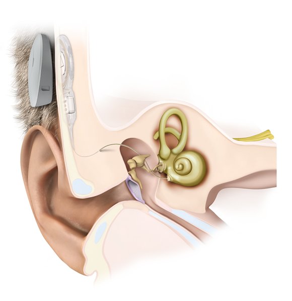 Middle ear hearing aid - Vibrant Soundbridge