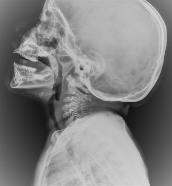 Xray Neck Lateral View Showing Adenoid Hypertrophy
