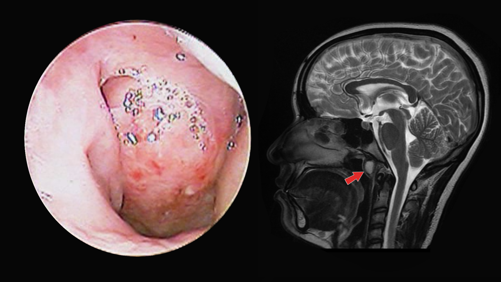 Tornwaldt cyst – Clinical presentation, Diagnosis and Treatment