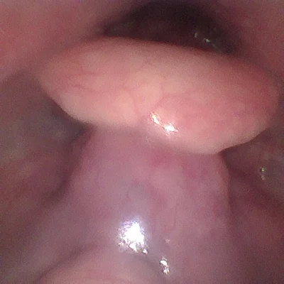 ENT Quiz – Swelling in base of tongue